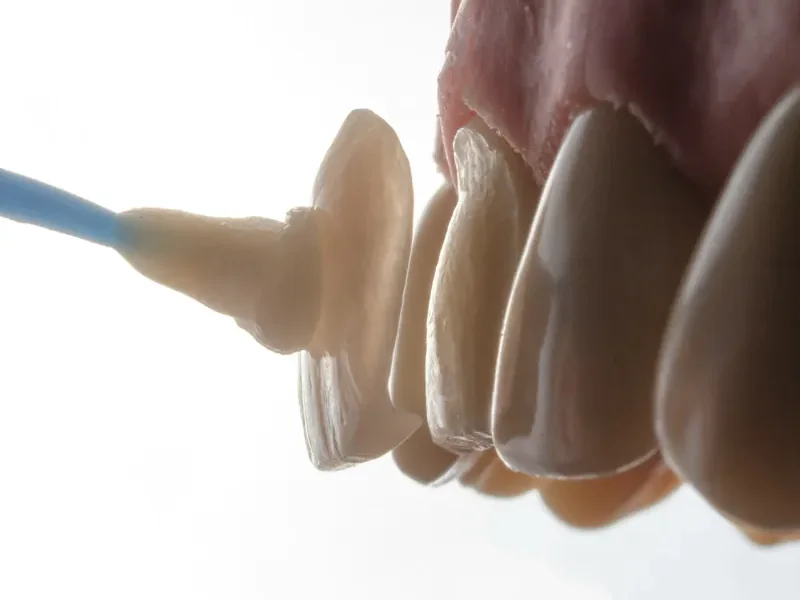 Veneers