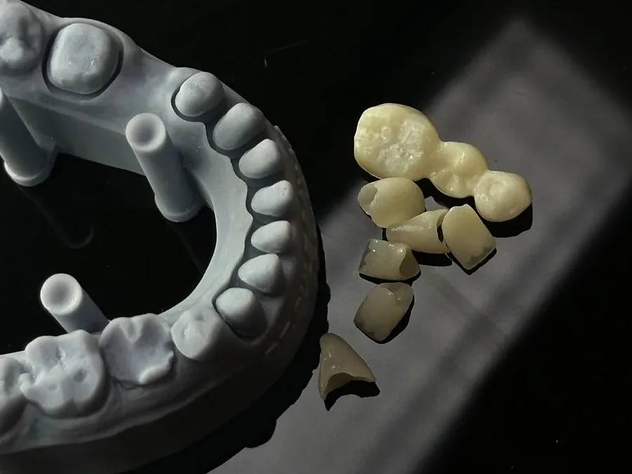 Dental model with ceramic crowns and a bridge